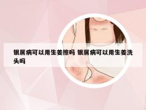 银屑病可以用生姜擦吗 银屑病可以用生姜洗头吗