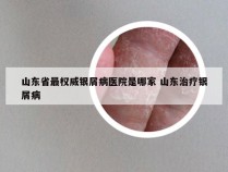 山东省最权威银屑病医院是哪家 山东治疗银屑病
