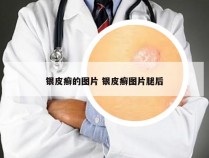 银皮癣的图片 银皮癣图片腿后