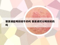 银屑病能喝核桃牛奶吗 银屑病可以喝核桃奶吗