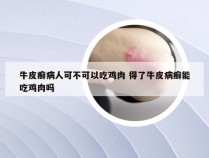 牛皮癣病人可不可以吃鸡肉 得了牛皮病癣能吃鸡肉吗