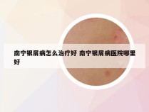 南宁银屑病怎么治疗好 南宁银屑病医院哪里好