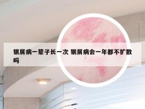银屑病一辈子长一次 银屑病会一年都不扩散吗