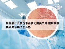 银屑病什么情况下会转化成关节炎 银屑病发展到关节疼了怎么办