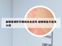 副银屑病怀孕期间会自愈吗 副银屑能不能生小孩