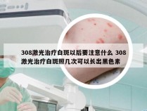 308激光治疗白斑以后要注意什么 308激光治疗白斑照几次可以长出黑色素