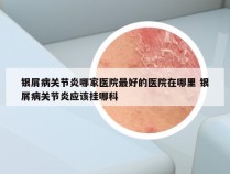 银屑病关节炎哪家医院最好的医院在哪里 银屑病关节炎应该挂哪科