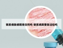 银屑病做病理用住院吗 银屑病需要做活检吗