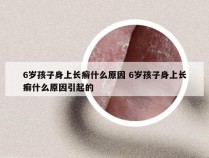 6岁孩子身上长癣什么原因 6岁孩子身上长癣什么原因引起的