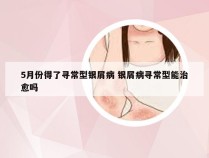 5月份得了寻常型银屑病 银屑病寻常型能治愈吗