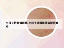 小孩子轻微银屑病 小孩子轻微银屑病能治好吗