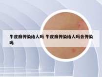 牛皮癣传染给人吗 牛皮癣传染给人吗会传染吗