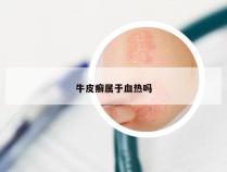 牛皮癣属于血热吗
