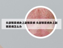 头部银屑病身上副银屑病 头部银屑病身上副银屑病怎么办