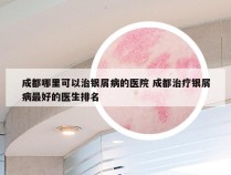成都哪里可以治银屑病的医院 成都治疗银屑病最好的医生排名
