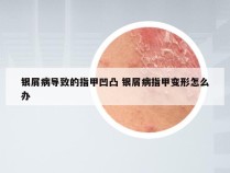 银屑病导致的指甲凹凸 银屑病指甲变形怎么办