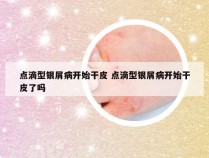 点滴型银屑病开始干皮 点滴型银屑病开始干皮了吗