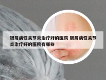 银屑病性关节炎治疗好的医院 银屑病性关节炎治疗好的医院有哪些