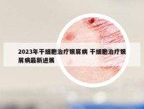 2023年干细胞治疗银屑病 干细胞治疗银屑病最新进展