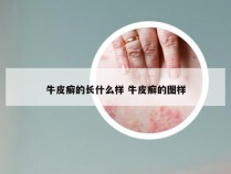 牛皮癣的长什么样 牛皮癣的图样