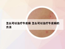 怎么可以治疗牛皮癣 怎么可以治疗牛皮癣的方法