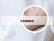 牛皮癣照紫光