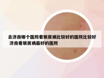 去济南哪个医院看银屑病比较好的医院比较好 济南看银屑病最好的医院
