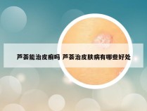 芦荟能治皮癣吗 芦荟治皮肤病有哪些好处