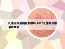 礼来治银屑病能去根吗 2020礼来新药根治银屑病