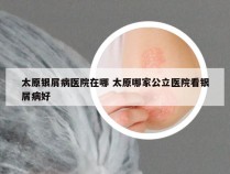 太原银屑病医院在哪 太原哪家公立医院看银屑病好