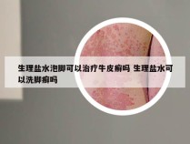 生理盐水泡脚可以治疗牛皮癣吗 生理盐水可以洗脚癣吗