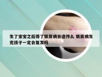 生了宝宝之后得了银屑病会遗传么 银屑病生完孩子一定会复发吗