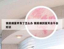 银屑病夏季发了怎么办 银屑病到夏天会不会好点