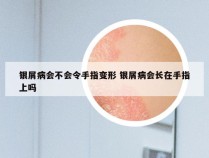 银屑病会不会令手指变形 银屑病会长在手指上吗