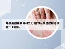 牛皮癣服用黄芪和三七粉好吗 牛皮肤癣可以吃三七粉吗