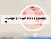 长治市医院治疗牛皮癣 长治市看皮肤病最好的