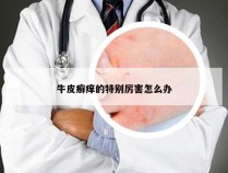 牛皮癣痒的特别厉害怎么办