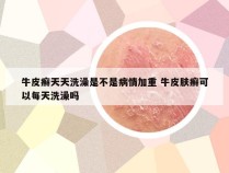 牛皮癣天天洗澡是不是病情加重 牛皮肤癣可以每天洗澡吗