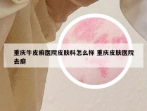 重庆牛皮癣医院皮肤科怎么样 重庆皮肤医院去癣