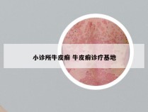 小诊所牛皮癣 牛皮癣诊疗基地
