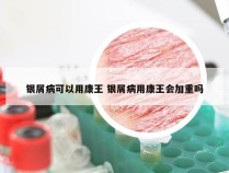 银屑病可以用康王 银屑病用康王会加重吗