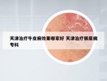 天津治疗牛皮癣效果哪家好 天津治疗银屑病专科
