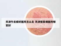 天津牛皮癣好医院怎么走 天津银屑病医院哪家好