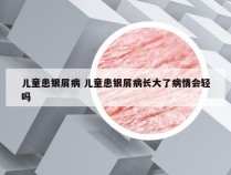 儿童患银屑病 儿童患银屑病长大了病情会轻吗