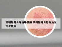柴胡加龙骨专治牛皮癣 柴胡加龙骨牡蛎汤治疗皮肤病