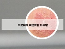 牛皮癣血常规有什么异常