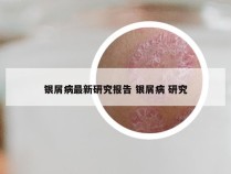 银屑病最新研究报告 银屑病 研究