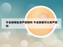 牛皮癣痒能用芦荟胶吗 牛皮肤癣可以用芦荟吗