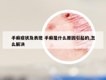 手癣症状及表现 手癣是什么原因引起的,怎么解决