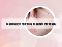 银屑病内脏会出皮损吗 银屑病会皮肤开裂吗